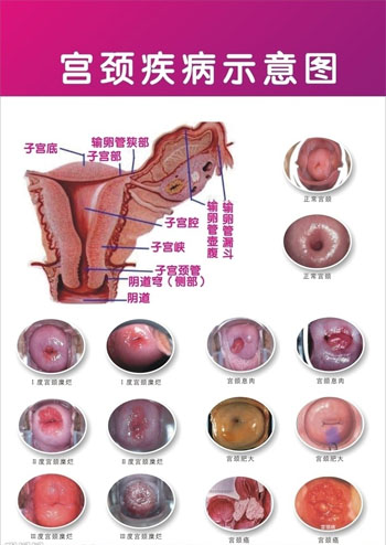 宫颈白斑的病因是什么？